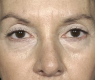 Blepharoplasty