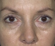 Blepharoplasty