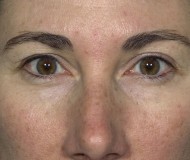 Blepharoplasty