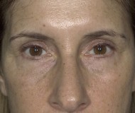 Blepharoplasty