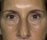 Blepharoplasty