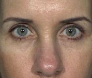 Blepharoplasty