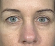 Blepharoplasty