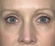 Blepharoplasty