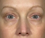 Blepharoplasty