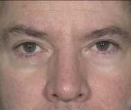 Blepharoplasty