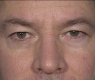 Blepharoplasty