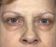 Blepharoplasty