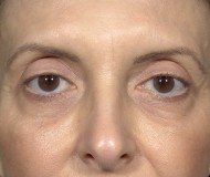 Blepharoplasty