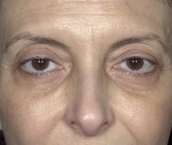 Blepharoplasty