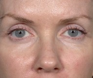 Blepharoplasty