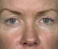 Blepharoplasty