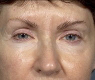 Blepharoplasty