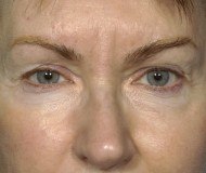 Blepharoplasty