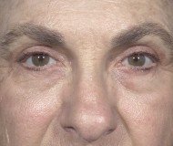 Blepharoplasty