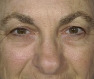 Blepharoplasty