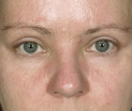 Blepharoplasty