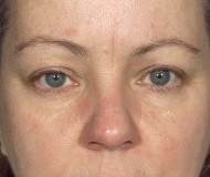 Blepharoplasty