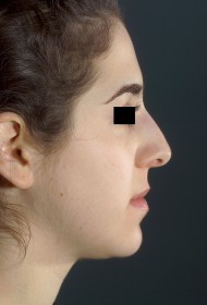 Rhinoplasty