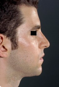 Rhinoplasty