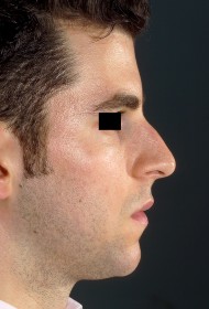 Rhinoplasty