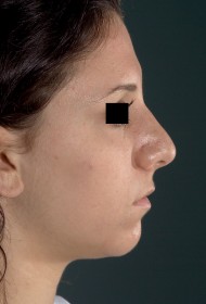 Rhinoplasty