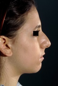 Rhinoplasty