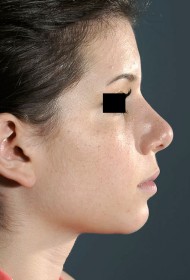 Rhinoplasty