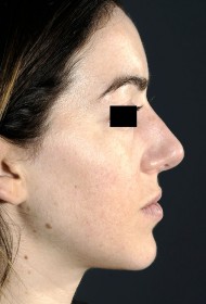 Rhinoplasty