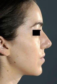 Rhinoplasty