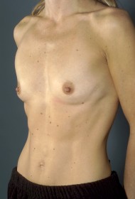 Breast Augmentation