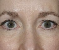 Brow Lift