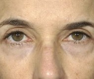 Blepharoplasty