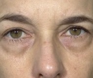 Blepharoplasty