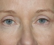 Blepharoplasty