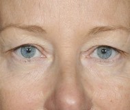 Blepharoplasty