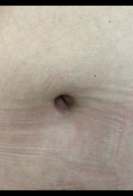 Abdominoplasty