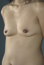 Breast Augmentation