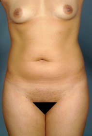 Before Image: Liposuction - front