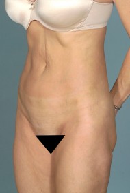 Liposuction