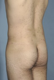 Liposuction