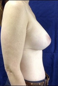 Breast revision