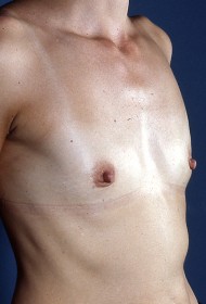 Before Image: Breast revision - right-front-oblique