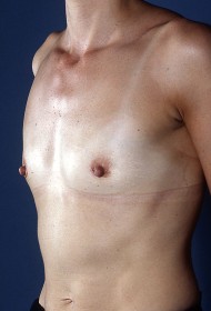 Before Image: Breast revision - left-front-oblique