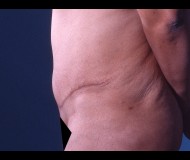 Abdominoplasty