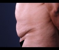 Abdominoplasty