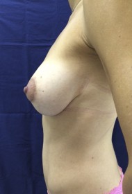 Breast Uplift- Augmentation