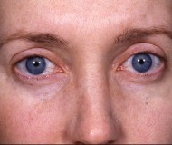 Blepharoplasty