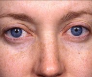 Blepharoplasty