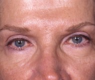 Blepharoplasty